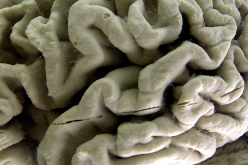 Predicting and Preventing Alzheimer's